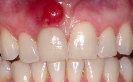 abscesos dentales